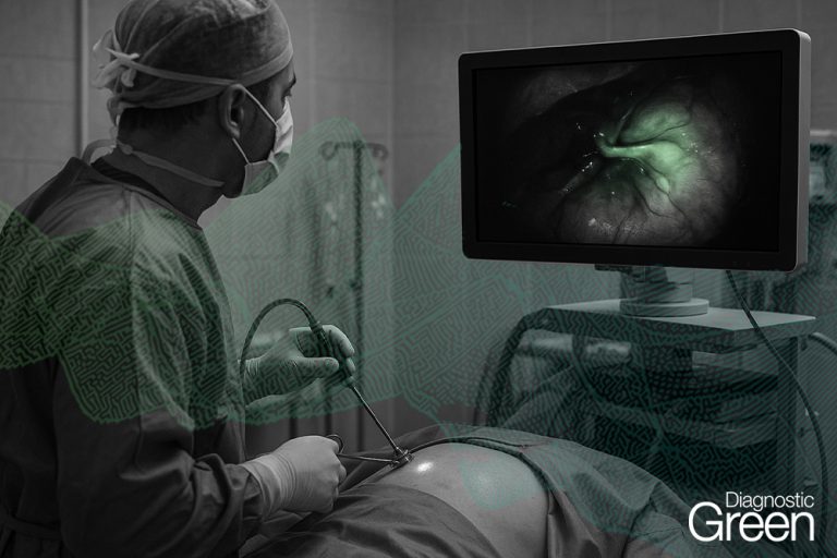 Integrating critical view of safety - Surgical Outcomes Of Conventional Versus Indocyanine Green Fluorescence Guided Laparoscopic Cholecystectomy In Acute Cholecystitis 768x512 